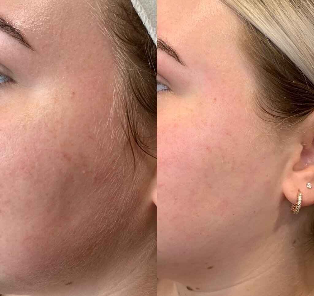 before+and+after+dermaplaning+6+1