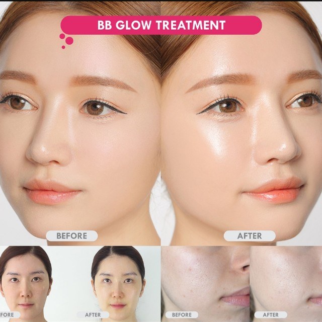 korean_bb_glow_treatment_limited_time_only_1522142159_535f2dd9